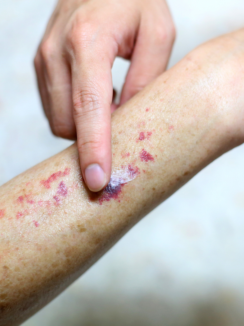 A person pointing at their arm with purple spots